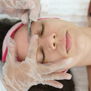 PEELING HOLLYWOOD - DERMAPLANING